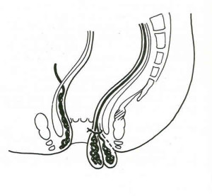 Emorroidectomia