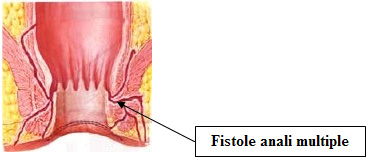 fistole-perianali-multiple